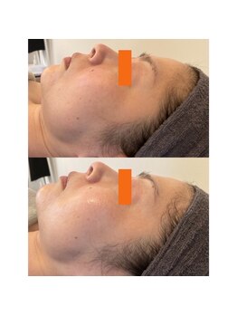 カウニス るる(kaunis)/【ララピール】Before After