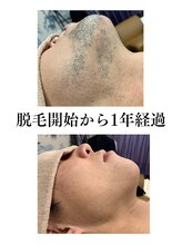 アンジェリーナ/ヒゲ脱毛/1年経過/都度払い