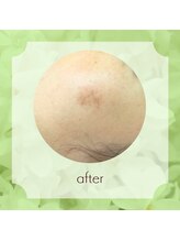 ビューティフィーサロン ベルル(Belulu)/シミケアアフター