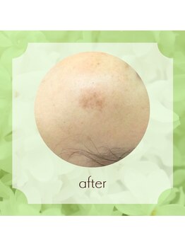 ビューティフィーサロン ベルル(Belulu)/シミケアアフター