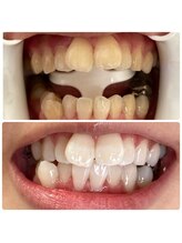 実夢(miyu)/医療提携ジェルビフォーアフター