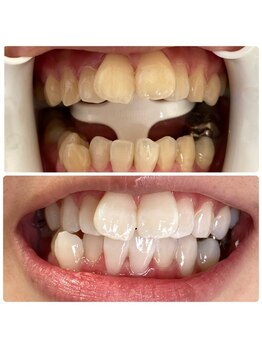 実夢(miyu)/医療提携ジェルビフォーアフター