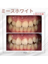 ミースホワイトニング(mys whitening)/ビフォーアフター【歯科提携】