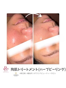 アクシア ビューティー サロン(AXSIA)/【REVIハーブピーリング】