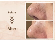 プラム(plum)/トルネード毛穴洗浄