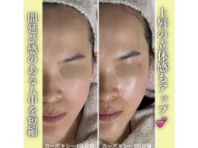 ハニエル(Haniel)/カーボキシー症例