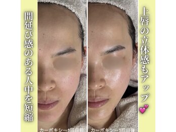 ハニエル(Haniel)/カーボキシー症例