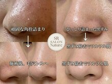 Facial Esthetic SR SALON Natureの雰囲気（【毛穴洗浄＋ニキビケア】肌荒れも即効改善!!）