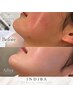 《術前・術後ケア60分》インディバ★フェイス 7,000円