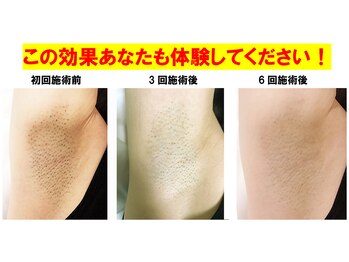 バランス鍼灸整骨院/わき脱毛　ビフォーアフター
