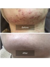 キッカ 梅田天六(Kikka)/ニキビケア＊ハーブピーリング