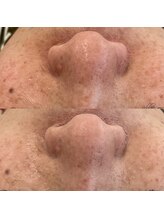 ヴェルシック(Belchic)/毛穴ケア＆キメも細かく明るい肌