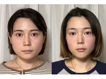 美容整体 アルマ/短期集中は施術効果もUP！