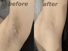 ルモア(RUMOR)/脱毛〈脇〉