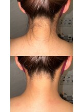 ワイズサロン(Y's salon)/うなじ脱毛