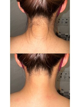 ワイズサロン(Y's salon)/うなじ脱毛