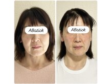 アバティック(ABatick)/小顔コルギ効果