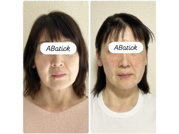 アバティック(ABatick)/小顔コルギ効果