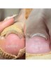 巻き爪矯正　モデルさん様募集！　フットワンカラーサービス（マグもOK）