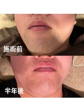 ラメール(La mer)/男性も脱毛する時代◎