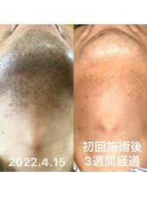 アシヤ髭ラボ(ASHIYA 髭 LABO)/あご脱毛ビフォーアフター