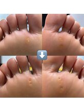 ドクターネイル爪革命 十条店/魚の目ケア