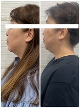 長寿鍼灸院 長寿整骨院/美容鍼50本の効果★小顔効果