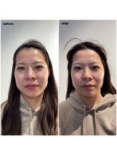 キャピタル(CAPITAL)/美脳小顔矯正　小顔　たるみ