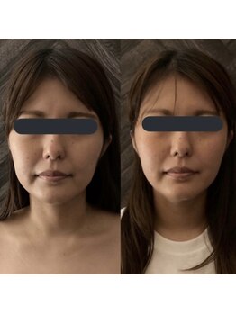 ハイコガオ 中崎町店(HIKOGAO)/小顔矯正