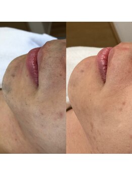 ノノケケ(NONOKEKE)/【メンズ脱毛】　ひげ脱毛