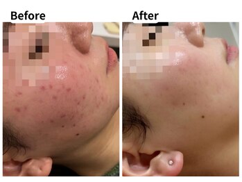 ムーロ バイ ミュー(muro. by mieux)/Before After