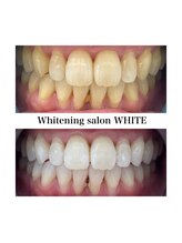 ホワイトニングサロン ホワイト 津山店(WHITE)/ビフォーアフター