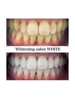 ホワイトニングサロン ホワイト 津山店(WHITE)/ビフォーアフター
