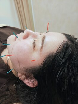 ムラサキ鍼灸治療院(MURASAKI鍼灸治療院)/シワ、たるみ、むくみに美容鍼