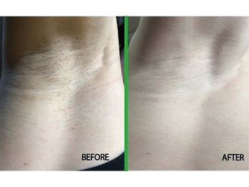 こふこふ/脇　脱毛