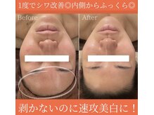 アリュールビューティー 下高井戸店(ALLURE BEAUTY)/ツヤ肌ララピール