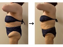 ドクターエイジレス(DR.AGELESS)/脂肪ケア剤導入コース3回