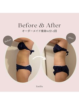 エミル(Emillu)/＊Body_ビフォーアフター
