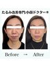 【歪みとほうれい線がひどい】自信を取り戻したい小顔(90分)◎26,900