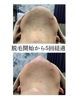 アンジェリーナ/ヒゲ脱毛/16回経過/都度払い