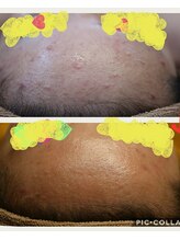 ベビースキン(baby skin)/ニキビ肌改善