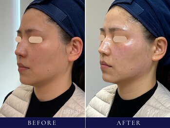 フローラル ビューティー(Floral-Beauty)/【ビフォーアフター】小顔エステ