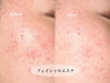 ビジュー(bjyou)/フェイシャルエステ