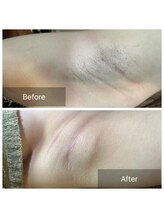 エルモア(L-MORE)/THR方式の光脱毛