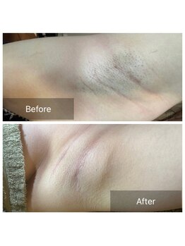 エルモア(L-MORE)/THR方式の光脱毛