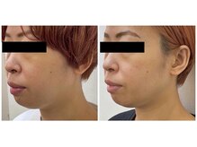 かとう鍼灸整骨院/◆３０女性　５回の施術例