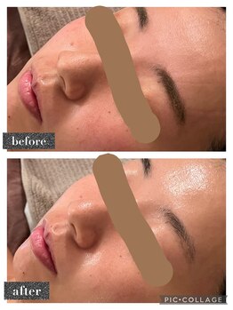 マンダ 田町(Manda)/肌質改善☆幹細胞フェイシャル