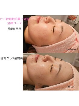 ウル バイ ラシック(Ulu by Lasic)/ヒト幹細胞培養上清液導入◎