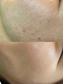 ユウビ ビューティー サロン(Yuubi)/【peel stage】ハーブピーリング