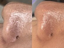 エミナル(Eminal)/◆毛穴フルコース　1回